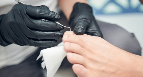 Είσφρυση όνυχος